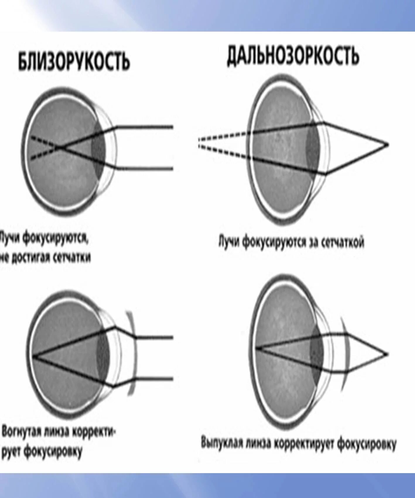 Минус и плюс в зрении. Дальнозоркость и близорукость плюс и минус. Зрение близорукость и дальнозоркость плюс и минус. Лучи фокусируются близорукость и дальнозоркость. Близорукость это плюс или минус.