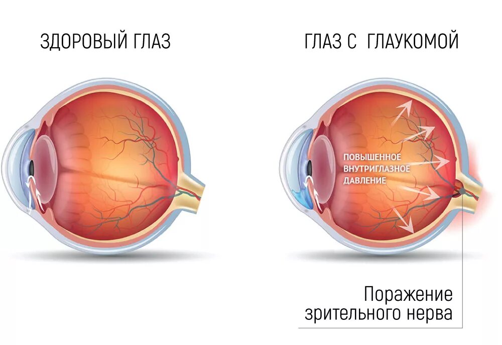 Катаракта глаза симптомы и лечение