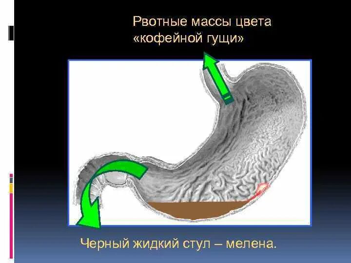 Рвотные массы цвета кофейной гущи. Рвотные массы цвета кофейной гущи признак. Рвотная масса кофейная гуща