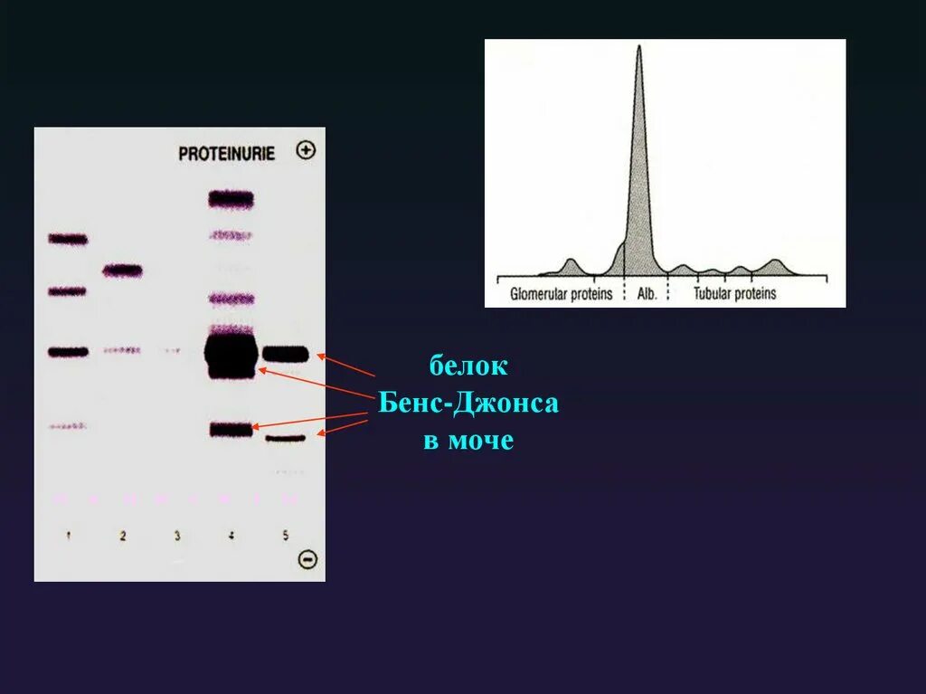 Белок Бенс Джонса. Белок Бенс-Джонса это м градиент. Анализ на белок Бенс Джонса. Определение белка Бенс-Джонса в моче методика.