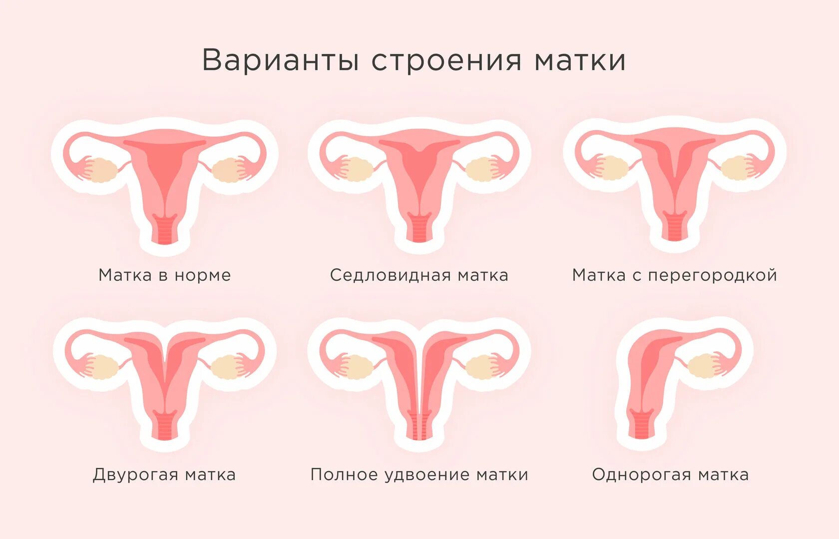 Что такое двурогая матка. Строение двурогой матки. Двурогая матка патология. Нормальная матка и двурогая. Двурогая седловидная матка.