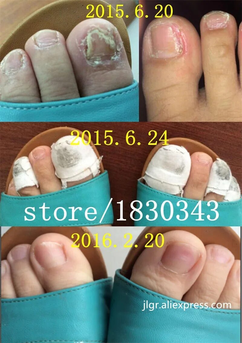 Грибок ногтей отзывы фото 10ml Toe Nail Fungus Treatment Kills 99.9% Bacteria Anti Fungal Nail Infection R