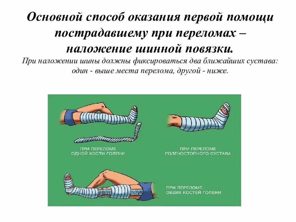 Какую первую помощь оказывают при переломе. Шину накладывают при переломах. первая помощь наложение шины. наложение шины на место перелома. наложение шины на нижнюю конечность.