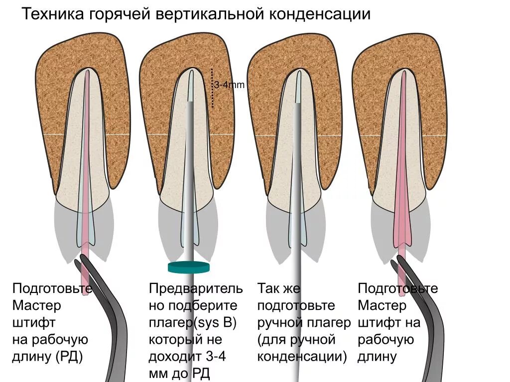 Сколько ходят с лекарством в зубе. Метод вертикальной конденсации для пломбирования корневых каналов. Вертикальная конденсация гуттаперчи методика. Вертикальная конденсация уплотнение гуттаперчи. Обтурация корневых каналов методом вертикальной конденсации.