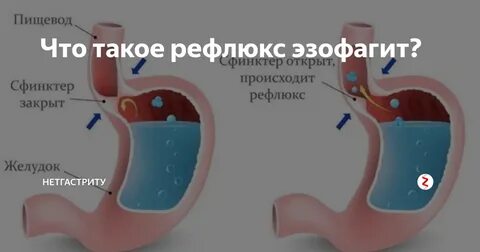 Эзофагит таблетки