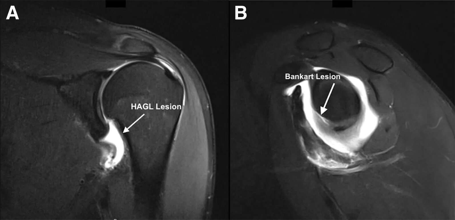 Повреждение Хилл-Сакса плечевого сустава мрт. Перелом Банкарта плечевого сустава мрт. Перелом Банкарта рентген. HAGL повреждение плеча на мрт. Разрыв губы гленоида