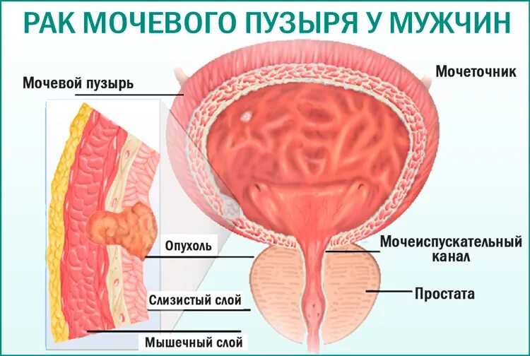 Симптомы мочевого пузыря у мужчин признаки. Злокачественные новообразования мочевого пузыря.