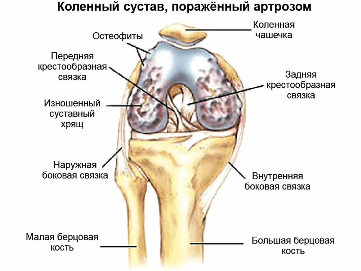 Изменения в коленных суставах. Коленный сустав анатомия артроз. Коленный сустав пораженный артрозом. Сустав коленный строение артроз. Вторичный остеоартрит коленного сустава.