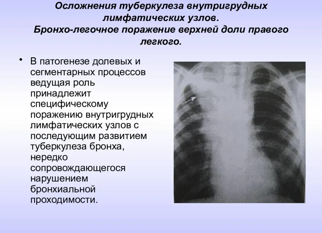 Осложнения туберкулеза внутригрудных лимфоузлов. Симптомы туберкулез лимфатических внутригрудных. Туберкулез внутригрудных лимфатических диагностика. Туморозный туберкулез внутригрудных лимфатических узлов. Лимфоузел в легком причина