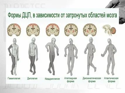 Церебральный паралич формы