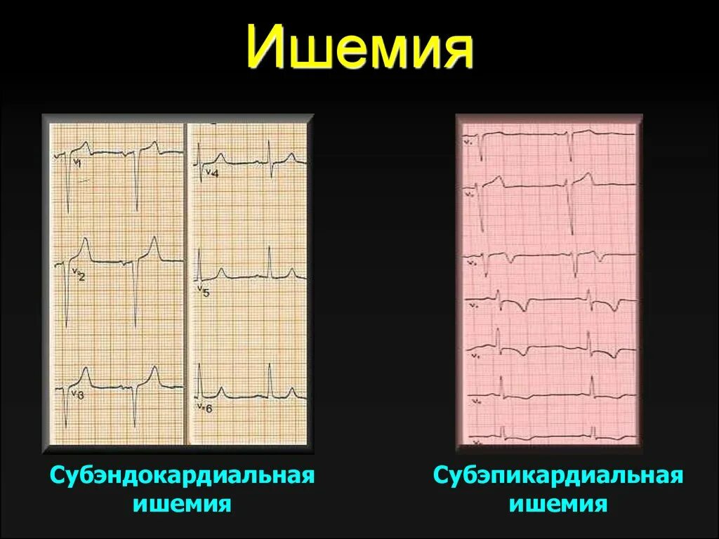 Субэндокардиальная ишемия миокарда на ЭКГ. Субэпикардиальная ишемия на ЭКГ. ЭКГ при ишемическом повреждении миокарда. Субэпикардиальная ишемия миокарда на ЭКГ.