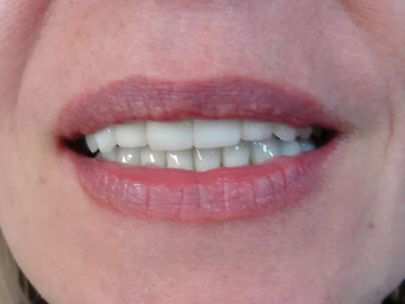 Зубы при закрытом рте. Правильные передние зубы.