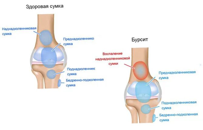 Упала сильно на колени. Гемартроз коленного сустава синяки.