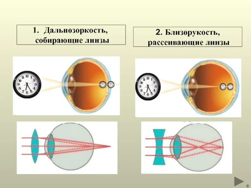 Дополните предложения изображение в близоруком