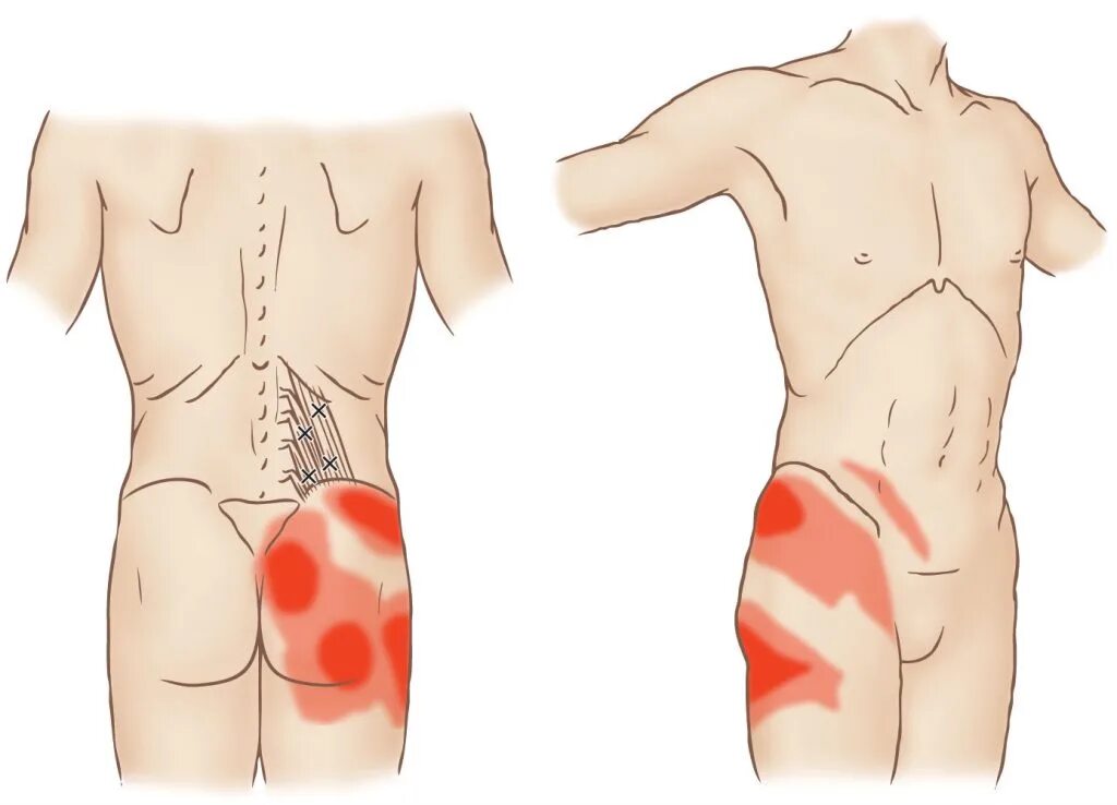 Подвздошно-поясничная мышца триггерные боли. Квадратная поясничная мышца триггерные точки. Синдром квадратной мышцы поясницы. Квадратная мышца поясницы триггерные точки.