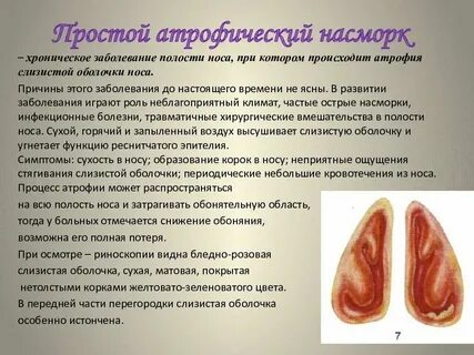 Атрофия слизистых лечение