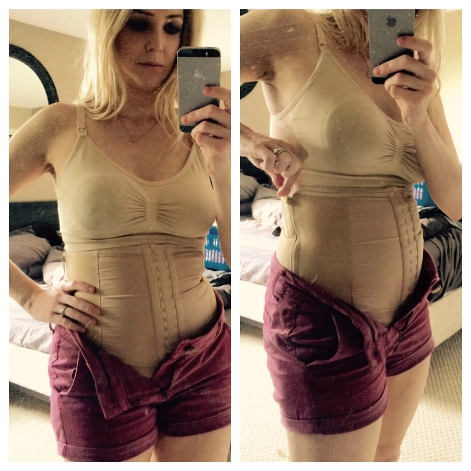 Rf лифтинг живота после родов. Живот сразу после родов и после. Диастаз после родов фото. Как восстановить живот после родов. Перевязка живота после родов.