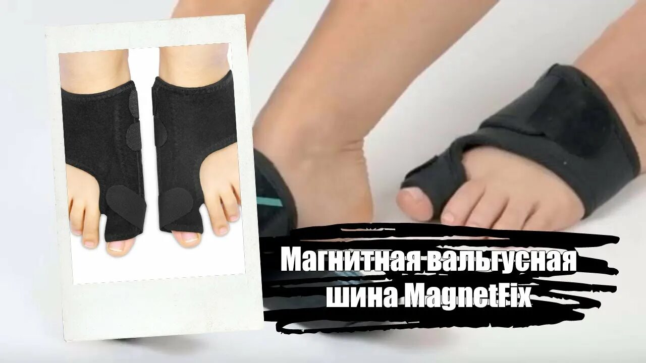 Как убрать вальгусную шишку