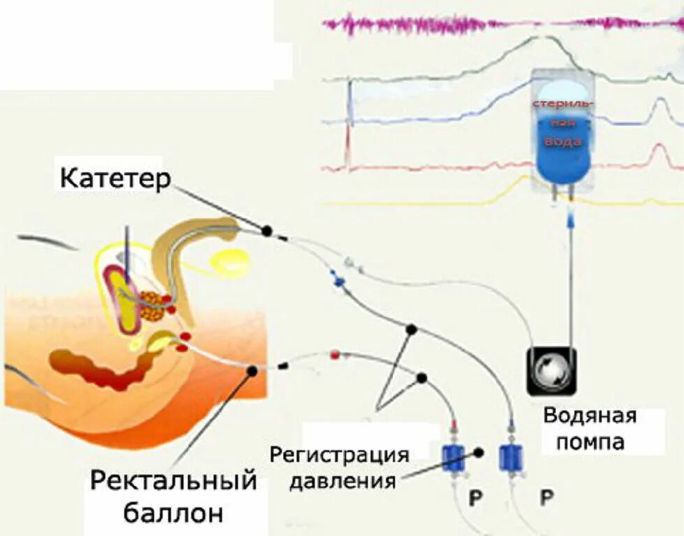 Ректальный анализ. Уродинамическое исследование мочевого пузыря для мужчин. Цистометрия и урофлоуметрия. Цистометрия наполнения. Цистометрия показания.