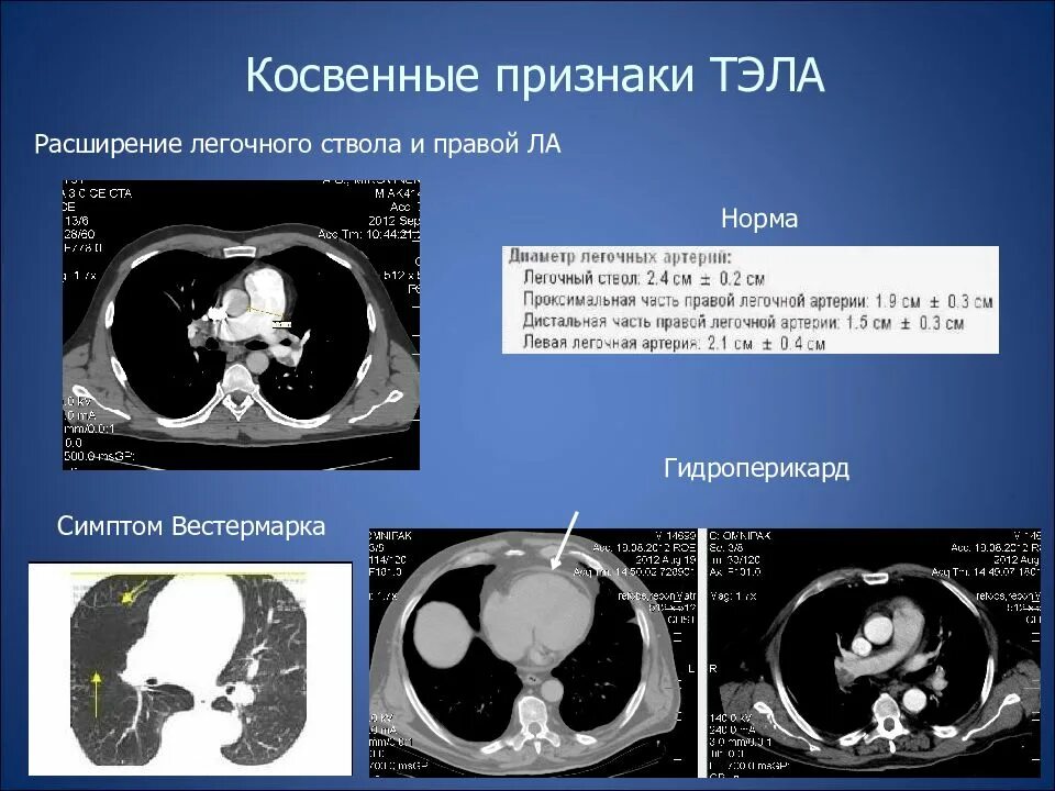 Признаки вчг. Ишемический инсульт кт протокол. Механическая травма пищевода это. Внутричерепная гипертензия нейросонография. Косвенные кт признаки.