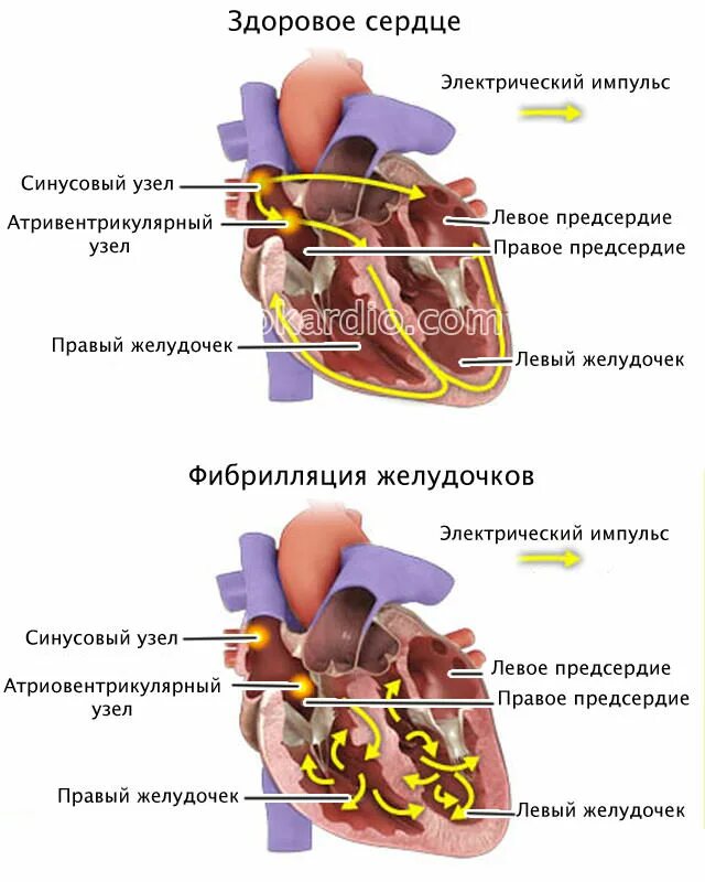 Фибрилляция сердца