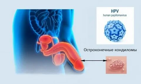 Причина папиллом на теле у мужчин