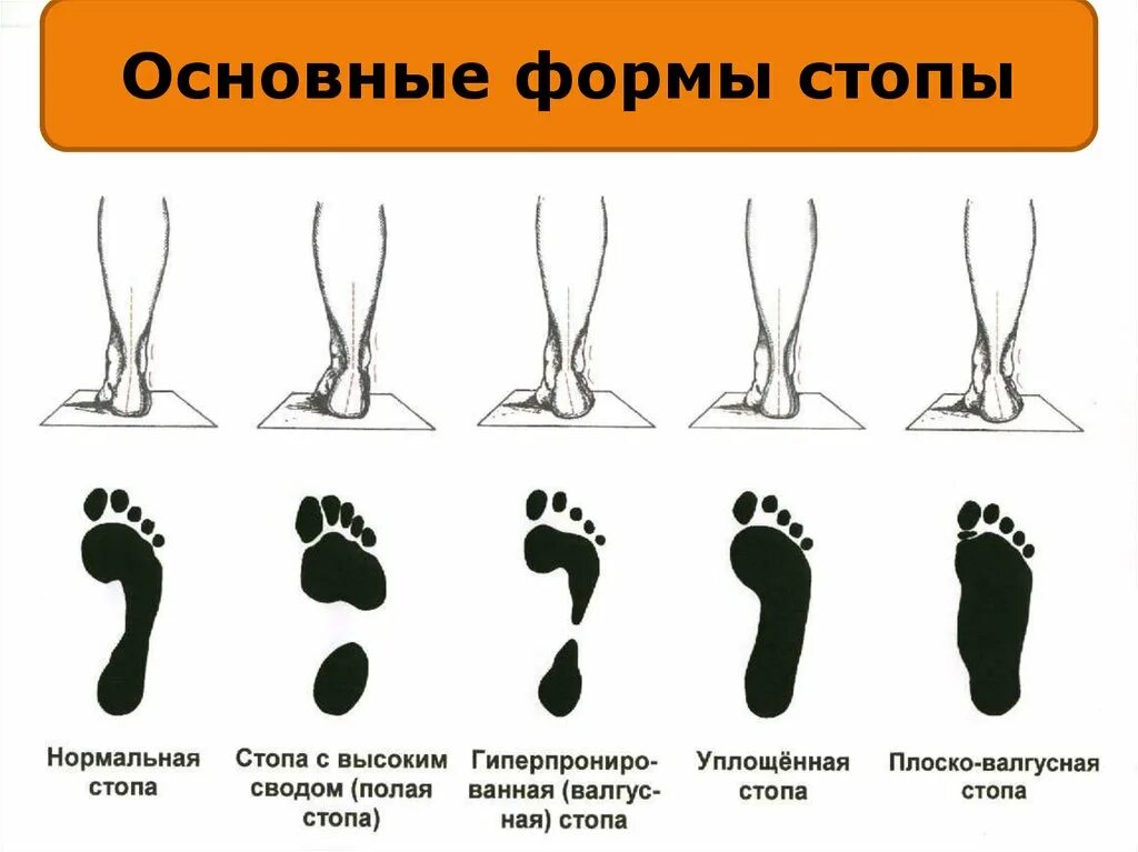 Плоскостопие поперечного свода стопы. Поперечное плоскостопие анатомия. Продольное поперечное и комбинированное плоскостопие. Стопа анатомия плоскостопие. Продольный и поперечный свод стопы.