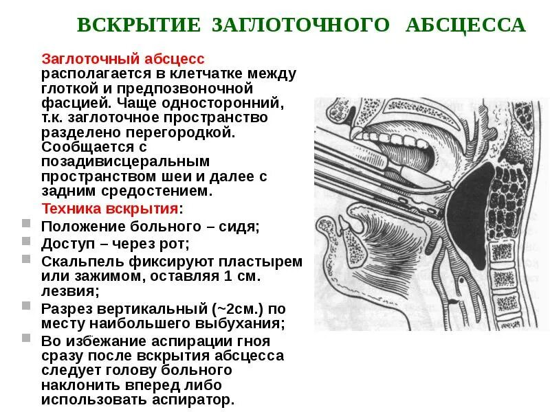 Паравезикальная клетчатка. Заглоточный абсцесс топографическая анатомия. Вскрытие ретрофарингеальных флегмон. Схема вскрытия паратонзиллярного абсцесса. Вскрытие заглоточного абсцесса осложнения.