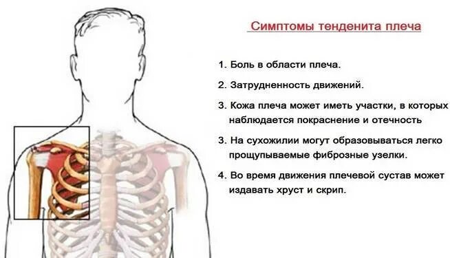 Боли проходящие при движении. Болит в левом плече спереди. болит спереди плеч. боль в плече спереди. болит левое плечо.