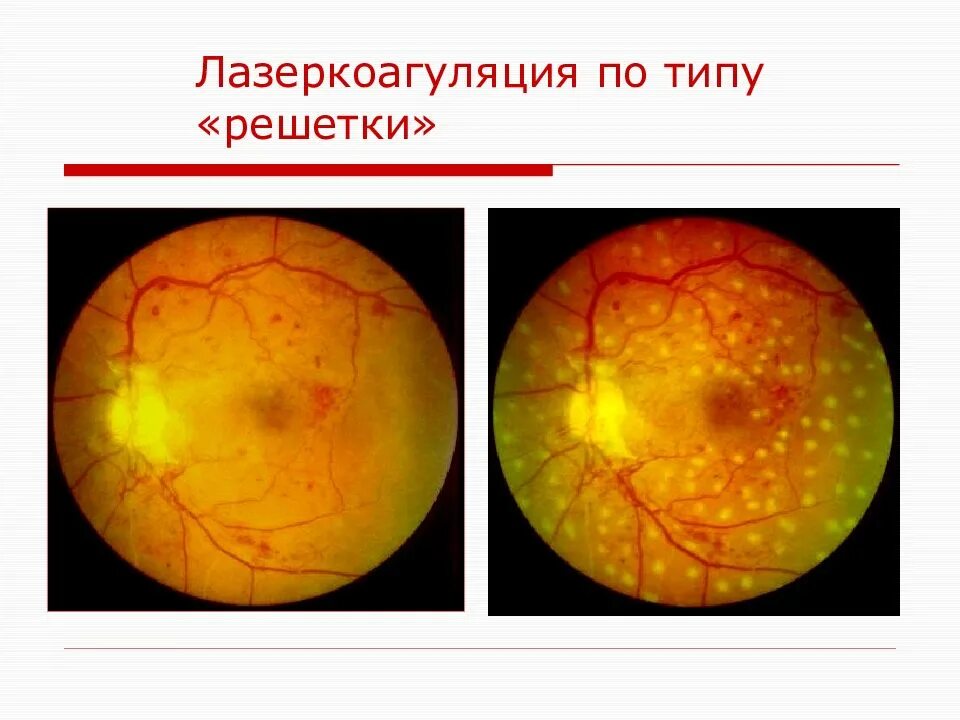 Диабетическая ретинопатия сетчатки глаза. Периферическая лазеркоагуляция сетчатки глаза. Лазеркоагуляция сетчатки при диабетической ретинопатии. Панретинальная лазерокоагуляция.