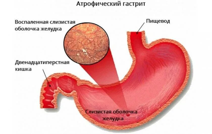 Эритематозный антральный антральный гастрит. Атрофический гастрит c1. Атрофия слизистой антрального отдела желудка Тип с-1. Антральный и фундальный гастрит. Диффузный антральный