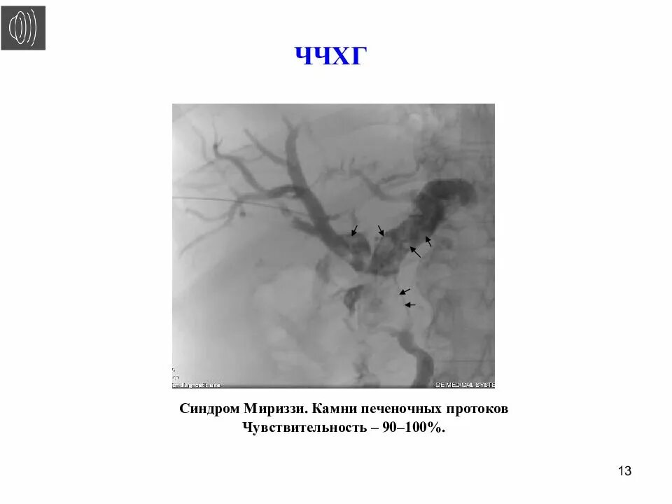 Чрескожная через печеночная холангиография. Чреспеченочная холангиография. Чреспеченочная холангиография. Чреспеченочная холангиография. Чреспеченочная холангиография.