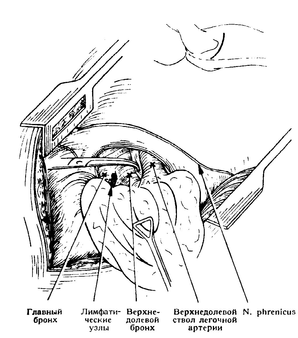 Операция левого легкого. Лобэктомия верхней доли легкого. Лобэктомия при абсцессе легкого. Лобэктомия и пневмонэктомия. Лобэктомия легкого операция техника.