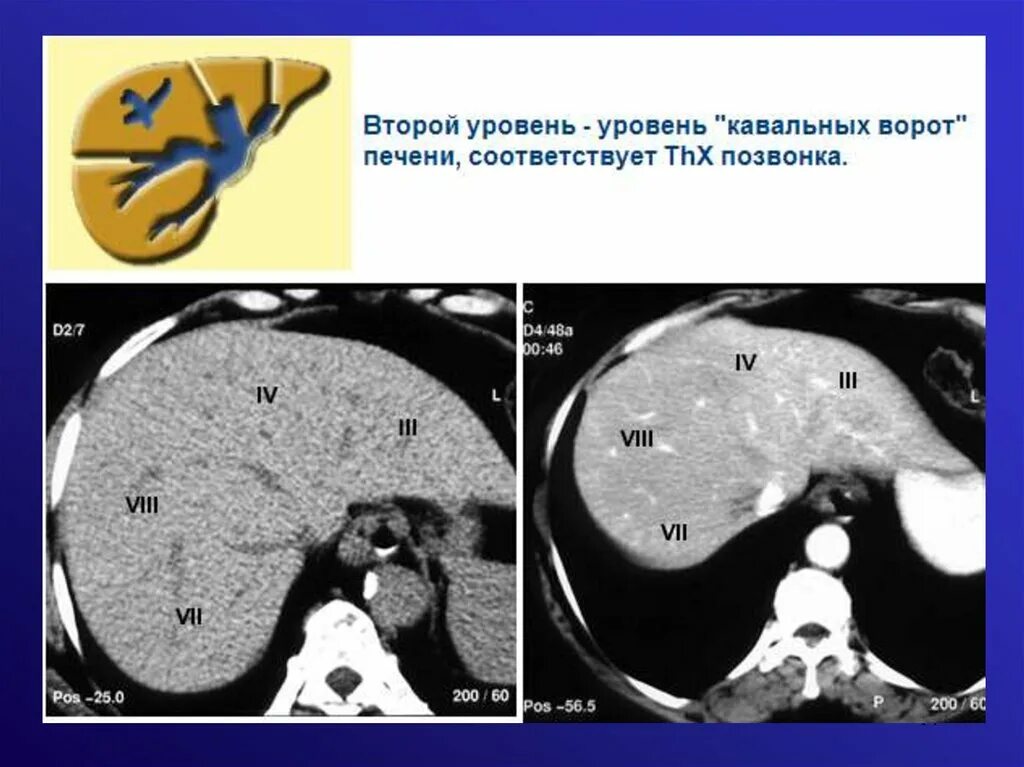 Сегменты печени кт. Опухоль ворот печени кт.