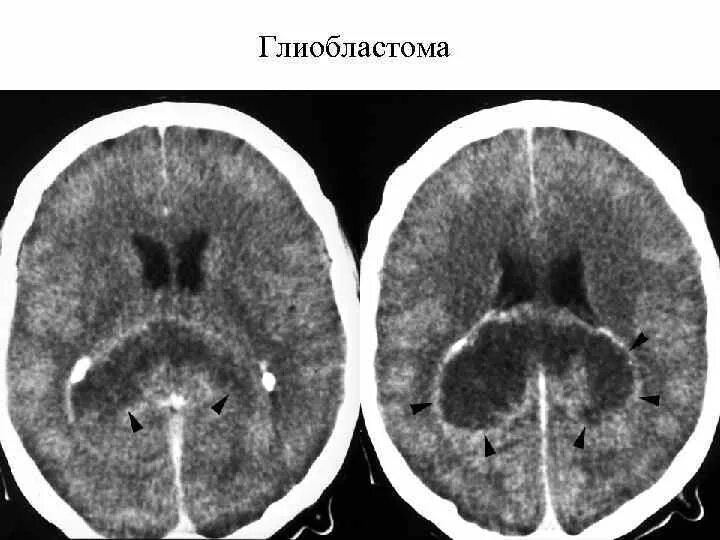 Неоперабельная опухоль мозга глиобластома. Мультифокальная глиобластома. Глиобластома мозолистого тела мрт. Глиобластома головного мозга на кт. Глиальная опухоль головного