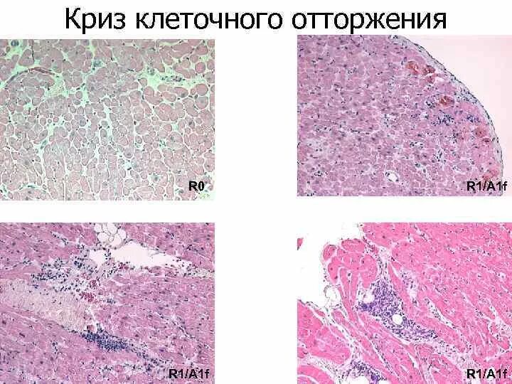 Отторжение функционального слоя. Криз отторжения трансплантата. сверхострое отторжение это. реакция отторжения трансплантата механизм. сверхострое отторжение трансплантата.