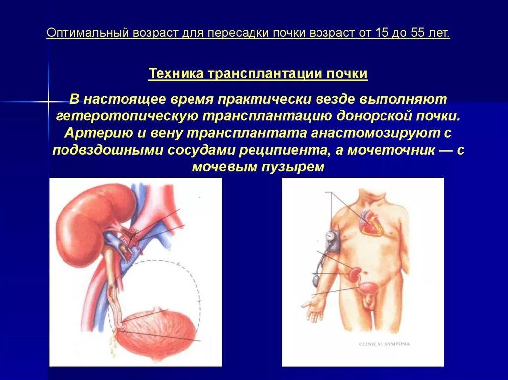 Техника трансплантации почки. Принципы трансплантации почки. Операция по трансплантации почки. Понятие о трансплантации почки.. Пересадка почки в москве