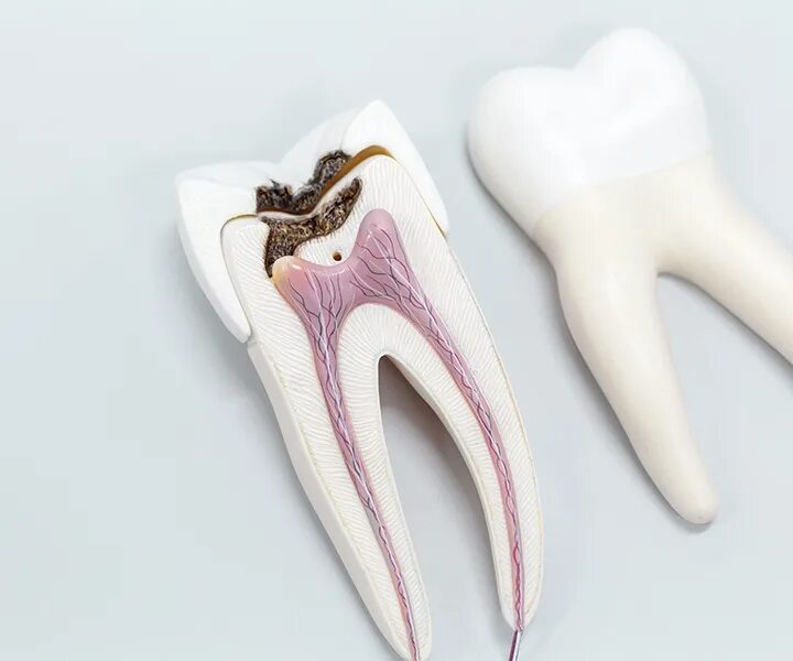 Root canal. Глубокий пришеечный кариес.