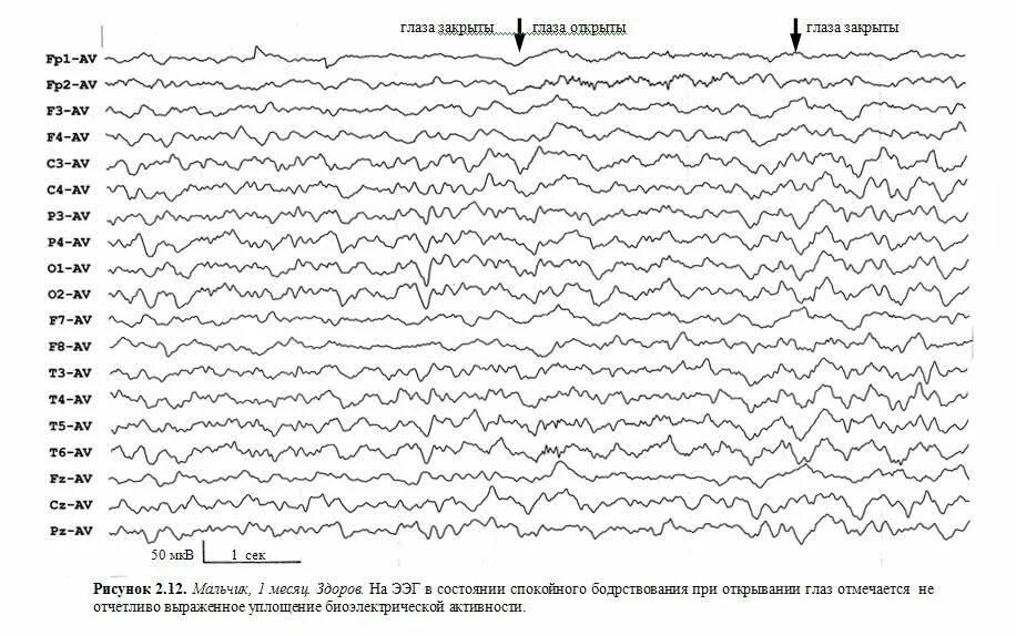 Как выглядит ээг. Рисунок нормальных показателей ЭЭГ. ЭЭГ нормального головного мозга. ЭЭГ головного мозга здорового человека график. ЭЭГ 8 лет норма.