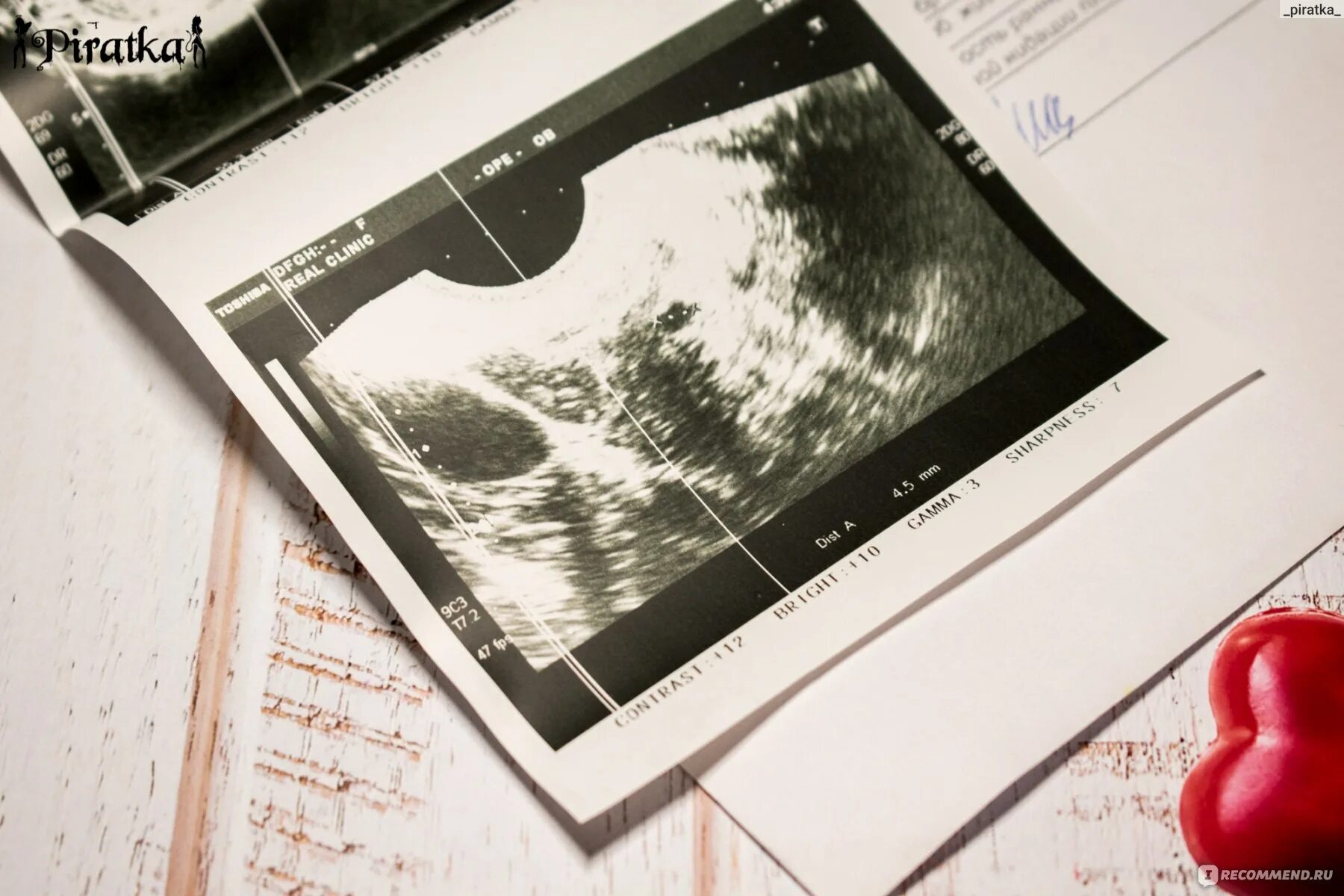 Узи отзывы спб. УЗИ мониторинг овуляции. Разница между УЗИ И акушерским сроком 3 недели беременности. Поздняя овуляция и беременность когда покажет УЗИ эмбрион.