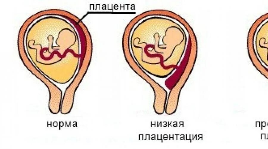 22 неделе плацента