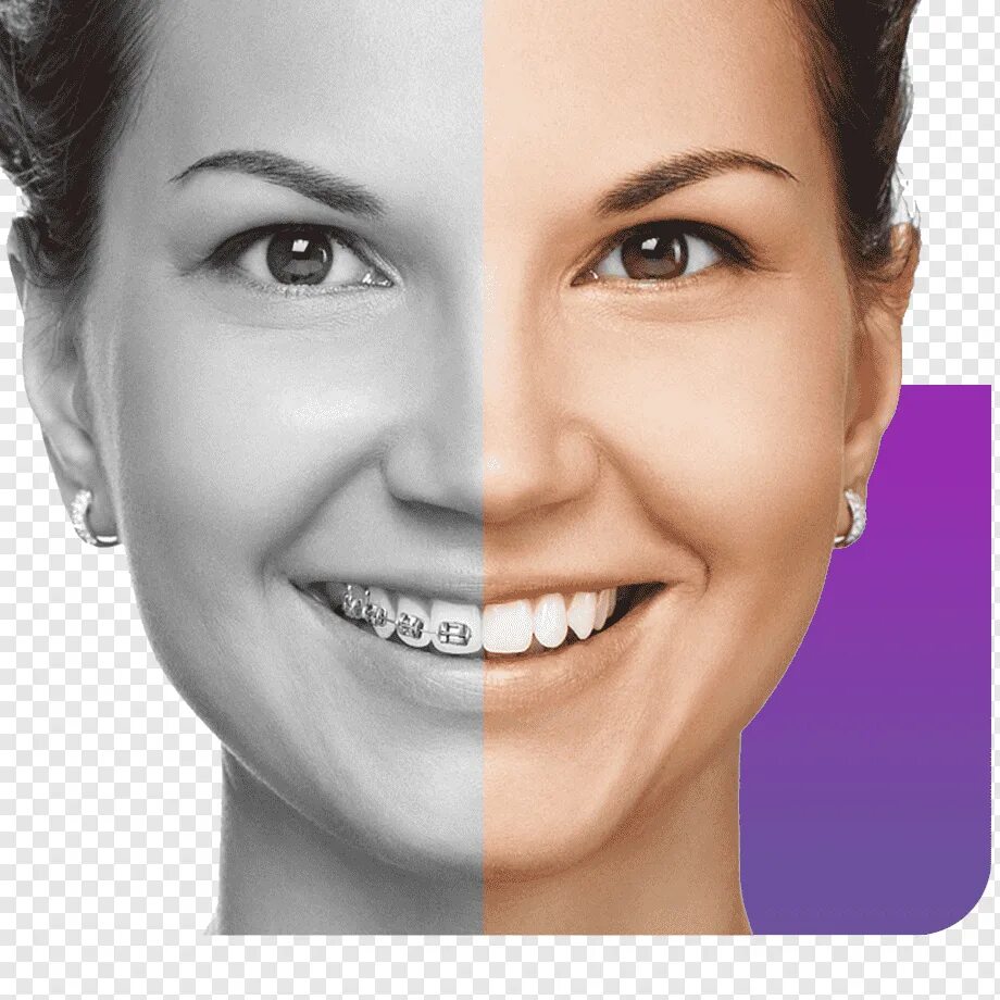 Example smile. Элайнеры star smile. элайнеров star smile.