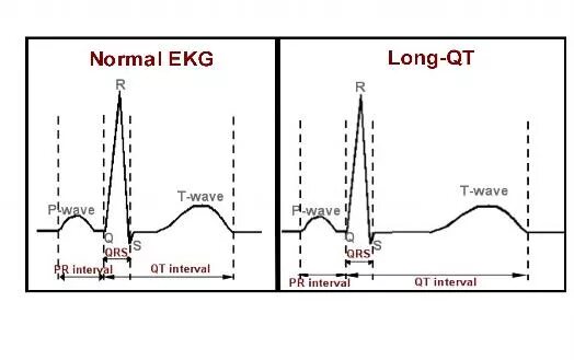 Удлиненное qt на экг. Синдром удлинённого интервала qt. Синдром удлинения интервала qt. Синдром удлиненного интервала qt на ЭКГ. Синдром удлиненного и укороченного интервала qt.