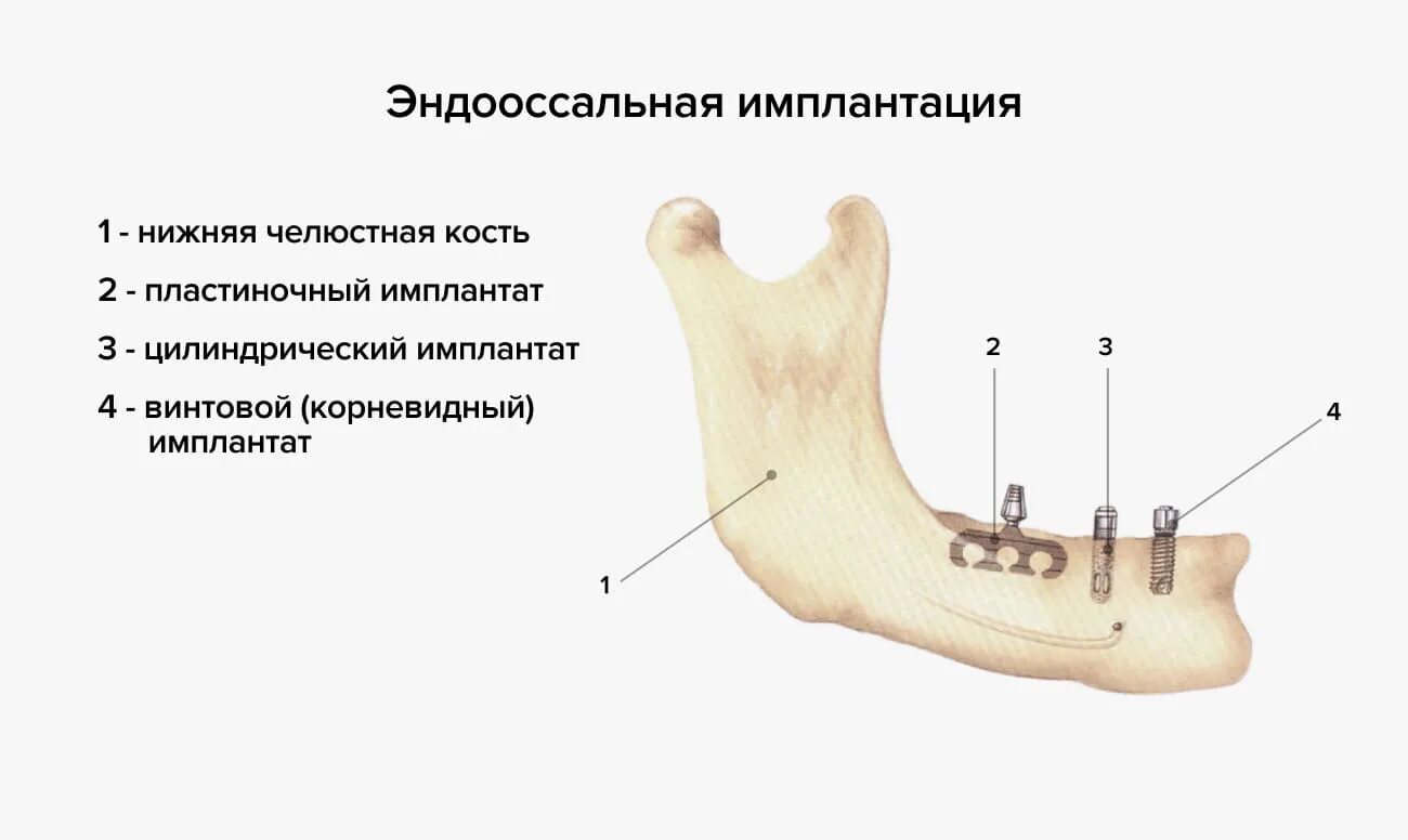 Эндооссально-субпериостальная имплантация. Пластиночные эндооссальные имплантаты. Эндооссальная (внутрикостная) имплантация. Эндодонто эндооссальные имплантаты.