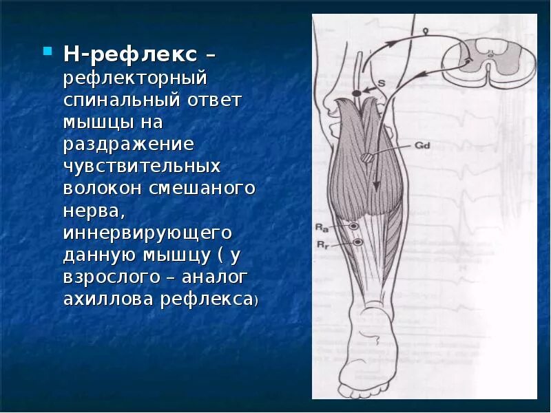 Ахиллов рефлекс нерв. H рефлекс ЭНМГ. Н-рефлекс при электромиографии. М-ответ и н-рефлекс.