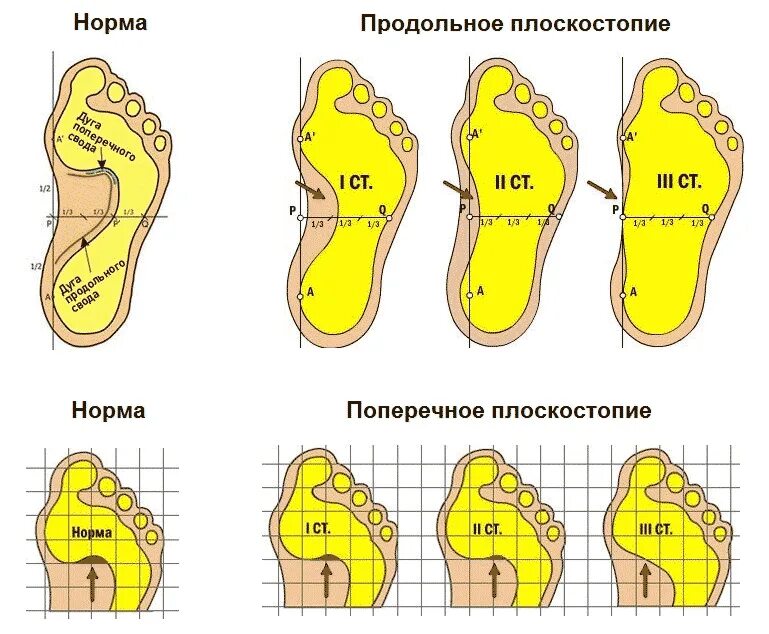 Средняя стопа. Отпечаток стопы 3 степени плоскостопия. Плантограмма продольное плоскостопие. Продольный поперечный комбинированный плоскостопие. Поперечное и комбинированное плоскостопие 1--2 степени.