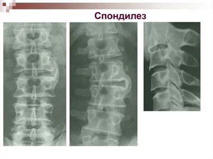 Спондилез шейном позвоночнике симптомы