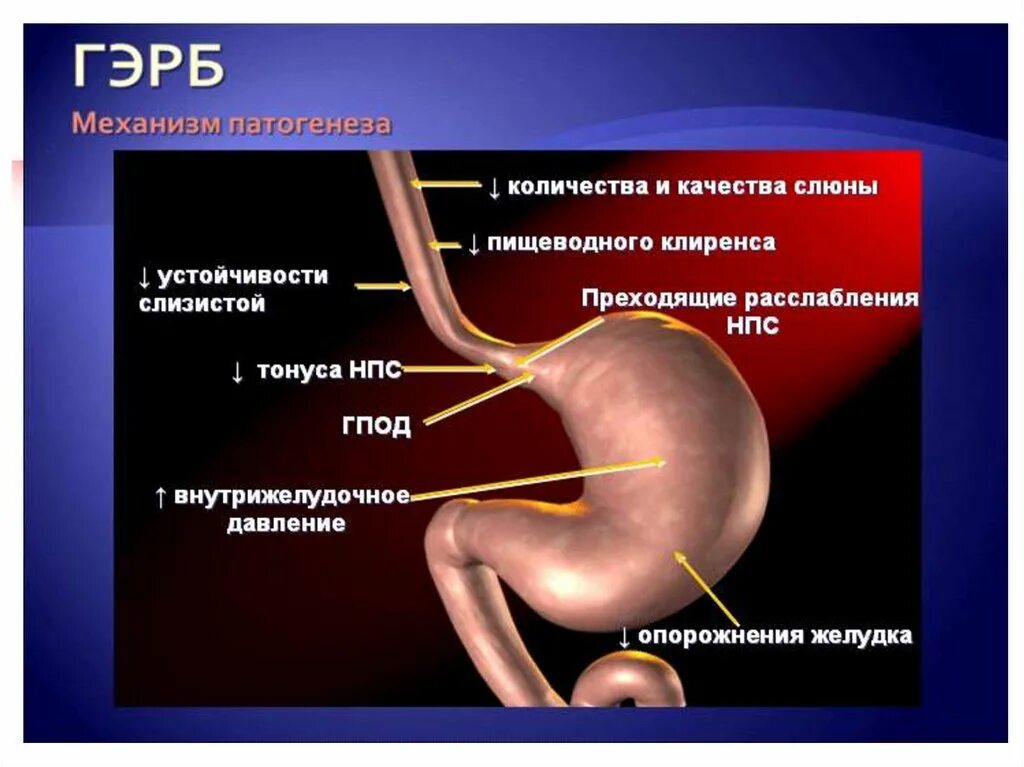 Рефлюксная болезнь симптомы у взрослых