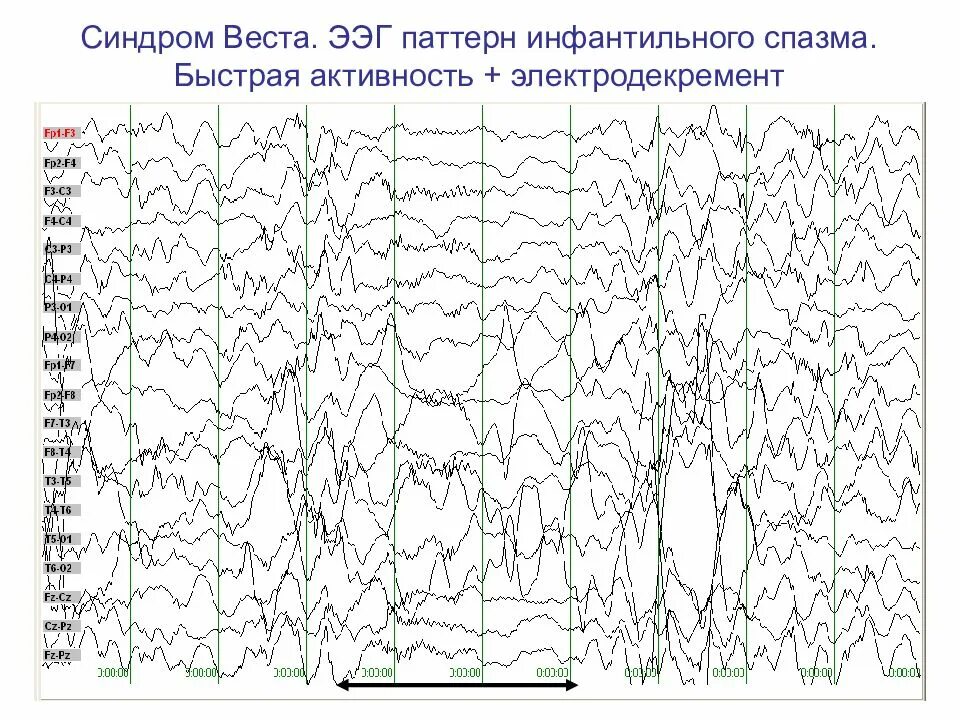 Паттерны ээг. Эпилептические паттерны на ээг. иктальный паттерн на ээг при эпилепсии. региональная эпилептиформная активность ээг.