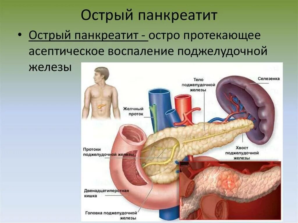 Панкреатин болезнь симптомы и причины. Острый панкреатит поджелудочной железы. панкреатин поджелудочная железа. хроническое воспаление поджелудочной железы. воспаление поджелудочной панкреатит симптомы.